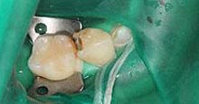 ラバーダム防湿を使った治療の様子