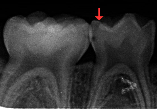 レントゲンで確認した虫歯