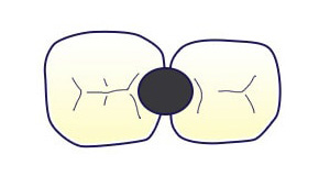 乳歯冠の説明